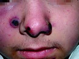 Is that a good antibiotic for it? Nasal Vestibulitis And Nasal Furunculosis And Mucormycosis Springerlink