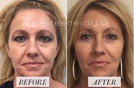 Filler & botox rejuvenation on my 40 year old patient. Our Guide To Facial Fillers From Treatment Options To Recovery Time Allure