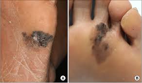 According to the american cancer society, just over 100,000 new cases of skin cancer are diagnosed in the united states each year. Acral Lentiginous Melanoma A Black Irregular Large Patch On The Left Download Scientific Diagram