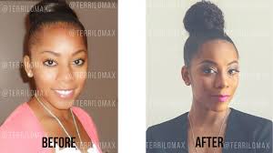 I have very thin edges, what specific natural styles do you recommend that won't make me look like a these styles also made my thinning edges all the more apparent. How A Hair Transplant Can Reverse Traction Alopecia And Thinning Edges