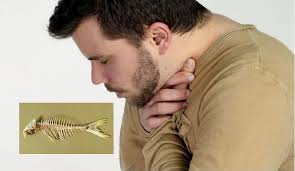 Dia jolok nak carik tulang tu. Petua Tercekik Tulang Ikan Umpan