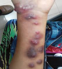 Image result for Nodular Lymphangitis