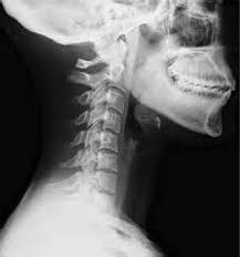 The head rests on the top part of the vertebral column, with the skull joining at c1. Neck Anatomy Pictures Bones Muscles Nerves