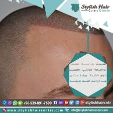 اصابك صلع مبكر أو لديك فراغات في ذقنك او شاربك اطمئن فلدينا طاقم طبي متميز مدرب علي أعلي مستوي من الكفاءة لزراعة الشعر بدون الم مطلق Stylish Hair Hair Clinic