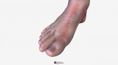 Sadaka f (2012) red blood cell transfusion in sepsis: Lymphangitis Skin Disorders Msd Manual Consumer Version