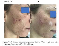 It's tretinoin's ability to fight both acne and improve overall skin condition that makes it so special. Efficacy And Tolerability Of A Tretinoin 0 02 Clindamycin 0 8 And Glycolic Acid 4 Gel In Acne A Multicenter Prospective Pragmatic Assessor Blinded 12 Week Trial On 159 Subjects