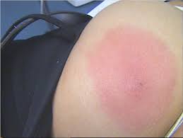 Кружись, кружись под звонкий гобой. Dermato Info Les Infections Bacteriennes