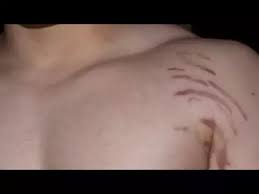 Your level of the hormone cortisol also might play a role. Does Weight Lifting Building Muscle Cause Leave Stretch Marks Quora