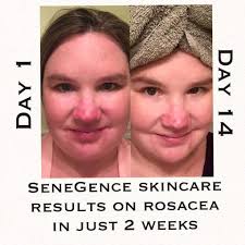 Unexpected skincare discovery for puffy face and redness