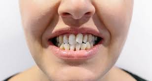 Snag Tooth: Snaggle Tooth Causes, Symptoms & Prevention