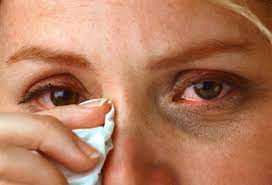 Red Itchy Watery Eyes Bahrain This Week Allergy Eyes Eczema Causes Eye Wash Solution