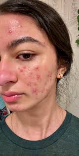 Accutite Vorher Nachher