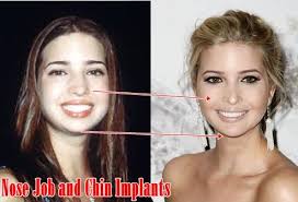 Pin On Nose Jobs
