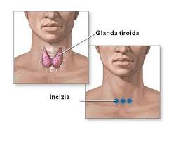 Este posibil să aveți tiroidita lui hashimoto fără să simțiți niciun singur simptom. Nodulii Glandei Tiroide Cand Trebuie OperaÈi Medpark