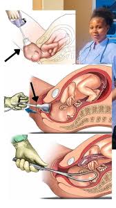 Image result for Vacuum Caput