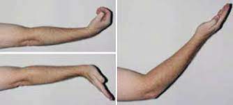 Atrapamiento Del Nervio Cubital En El Codo Sindrome Del Tunel Cubital Ulnar Nerve Entrapment At The Elbow Cubital Tunnel Syndrome Orthoinfo Aaos