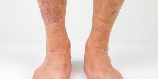More images for tanda tanda berbintik merah pada bahagian belakang badan » Bintik Merah Di Kaki Mungkin 9 Hal Ini Penyebabnya