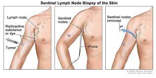 As part of the immune system, they help the body fight off infections and cancers. Lymph Node Surgery In Melanoma National Cancer Institute