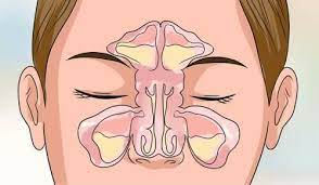 Hva er differensialdiagnoser til claudicatio intermittens og hvilke parakliniske undersøkelser er indisert ved mistanke? 6 Tips For A Apne En Tett Nese Pa Minutter Veien Til Helse