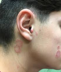 Image result for Tinea Capitis