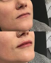 🌟 Case Study: Transforming Thin Lips 🌟 Our patient Lizzy came to us  seeking a solution for her naturally thin lips that left her feeling less  confident about her appearance. The challenge