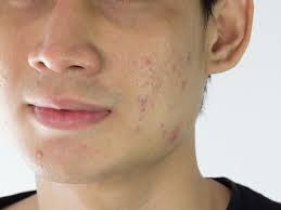 This bacterial infection causes small, red, itchy bumps that are usually painless. Skin Bumps That Look Like Pimples But Aren T Insider