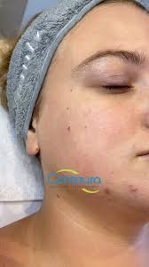 #moxi for the win! , Have you scheduled your treatment yet?