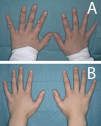 Not responsive to treatment severe recalcitrant psoriasis recalcitrant warts. Successful Treatment Of Refractory Cutaneous Warts Using Topical 3 Cidofovir In A Child After Heart Transplant The Journal Of Heart And Lung Transplantation