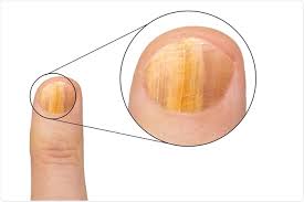 Image result for onychomycosis