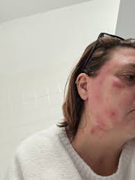 Do you suffer from acne, eczema, or rosacea?