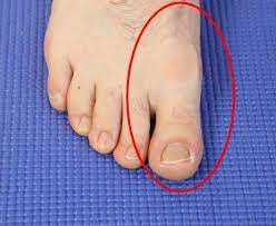 The smallest toe (5th) and the great toe (1st) are injured and broken more often than the other toes. Sprained Big Toe Tendon Pain Causes Symptoms Best Treatment