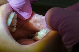 Image result for dental cancer