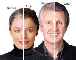 Celiac disease is a condition that leads to hair loss. Can A Gluten Free Diet Reverse Hair Loss