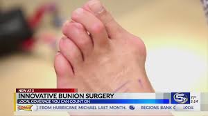 Newest (no scar) laser bunion removal. Special Report New Bunion Surgery Cuts Recovery Time Youtube