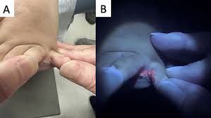 Image result for Erythrasma