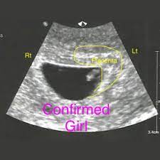 Jika hasil foto usg 3d masih berupa foto diam alias tidak bergerak, maka usg 4d menawarkan video empat dimensi. Ini Salah Satu Cara Mengetahui Ciri Hamil Anak Perempuan Trimester 2 Semua Halaman Nakita