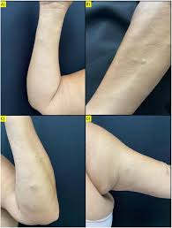 Image result for Nodule