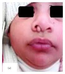 With each recurrence of submucosal edema, it becomes larger, until it appears as a smooth, pale tumor. A 3 Months Old Baby With Right Nasal Congenital Polyp Glioma B Download Scientific Diagram