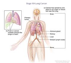 Swollen, hard, and enlarged lymph nodes may be a sign of nodal metastasis.6 lymph nodes are located in the neck, underarm, and groin. Lung Cancer Staging Virginia Oncology