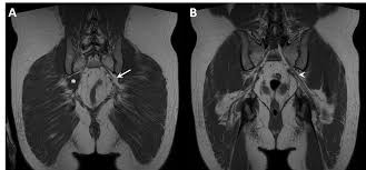 Anatomical drawing of the female pelvis. Cureus A Rare Anatomical Variant Of Unilateral Piriformis Muscle Agenesis A Case Report