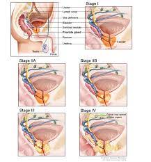 Bacteria in the prostate tissue of men with idiopathic prostatic inflammation. Prostate Cancer Treatment Mhealth Org