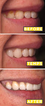 Maybe you would like to learn more about one of these? Veneers Before After The Decision The Prep The Results