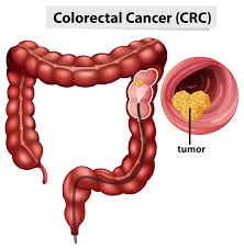 Image result for Constipation in Cancer