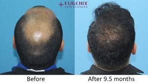 Shedding is when dogs naturally lose their old or damaged hair, with the amount and frequency depending on health and breed. Dr Bansal Dr Sethi International Boxer 5060 Grafts Scalp Beard 9 5 Months Post Op Hair Restoration Network Community For And By Hair Loss Patients