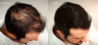 In others, it may become more apparent later in the 20′s or 30′s. Buy Maxx Pro Series Volumizing Hair Fibers With Real Keratin For Thinning Hair Hair Loss Dermatologist Tested And Certified Hypoallergenic 60 Days Supply Multiple Colors Available Dark Brown Online In Kazakhstan B07dwgxc92