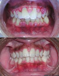 Image result for Gingivitis