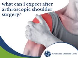 What to wear after shoulder surgery. What Can I Expect After Arthroscopic Shoulder Surgery