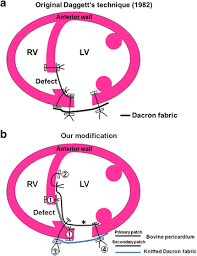 Usa.com provides easy to find states, metro areas, counties, cities, zip codes, and area codes information, including population, races, income, housing, school. A Modified Multi Patch Technique For Double Layered Repair Of Ischemic Posterior Ventricular Septal Rupture Surgical Case Reports Full Text