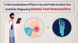 Image result for Probe-to-Bone Test