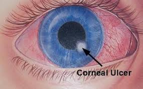 The Disorder Of Corneal Ulcer Is Actually An Unwrapped Wound On The Surface Of Cornea Of The Human Eye The Areas That Fall Within Corneal Ulcer Ulcers Corneal